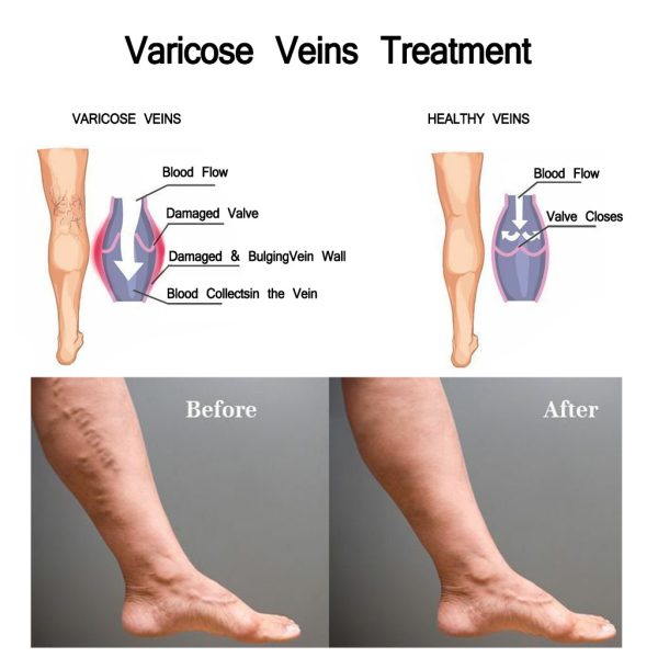 Varicose Cream - Image 2