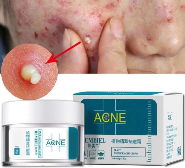 Acne cream - Image 4