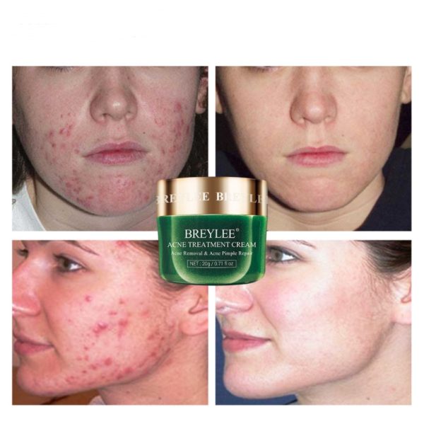 Tea tree acne cream moisturizing acne cream - Image 3
