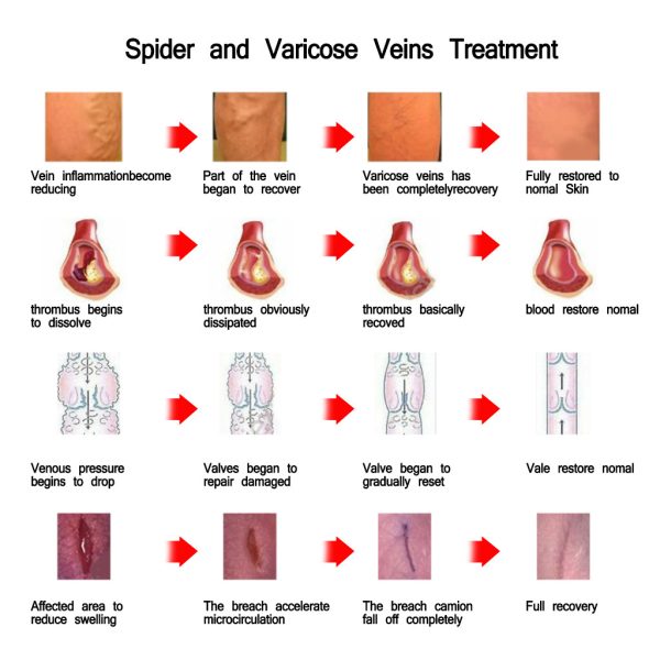 Varicose Cream - Image 3