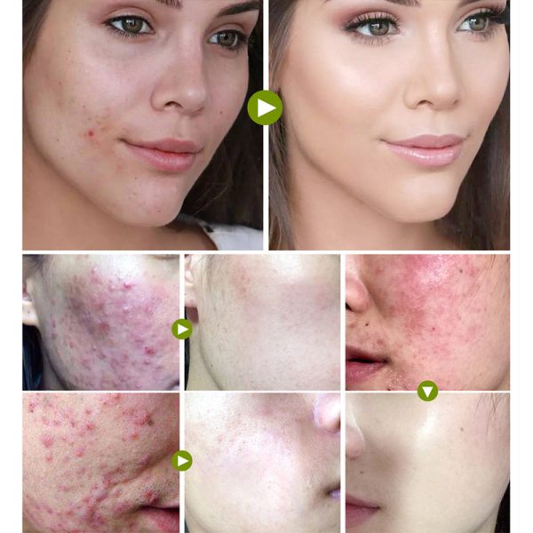 Tea tree acne cream - Image 2