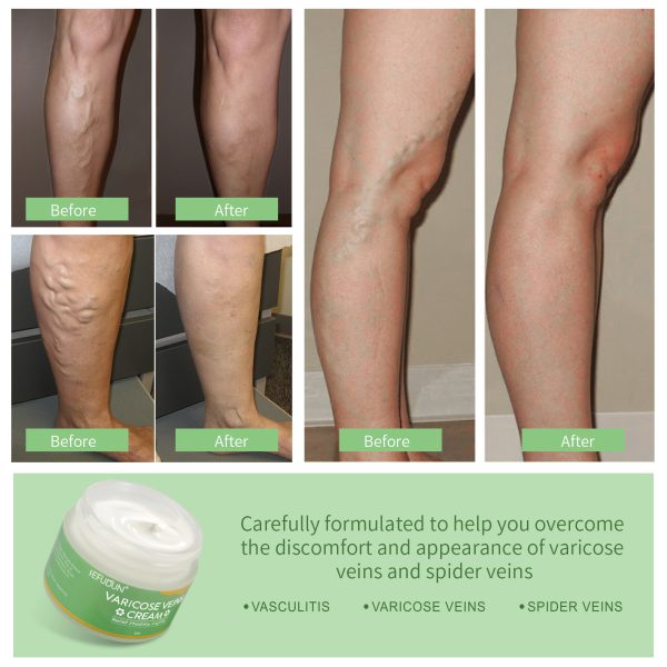 Vein Cream Red Blood Streaks Repair Earthworm Leg Bruises Bulge Relief Pain Safflower Ointment Varicose Cream - Image 5