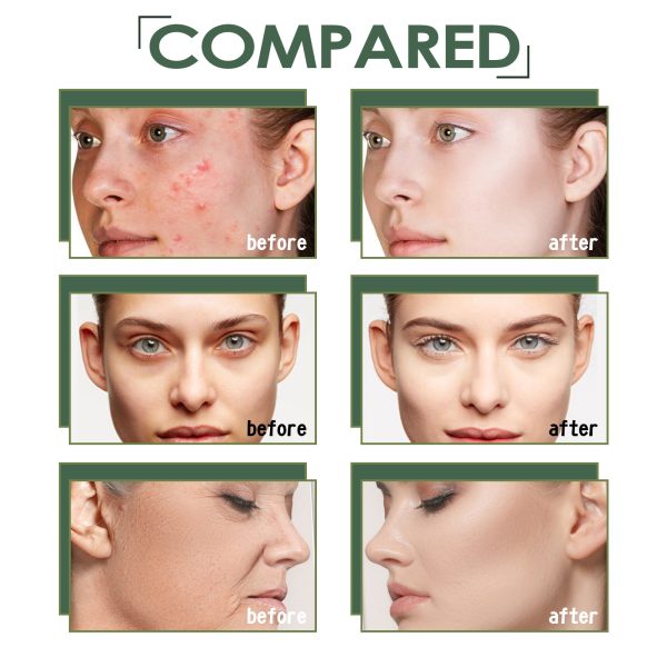 Acne Marks Blackhead Brightening Skin - Image 5