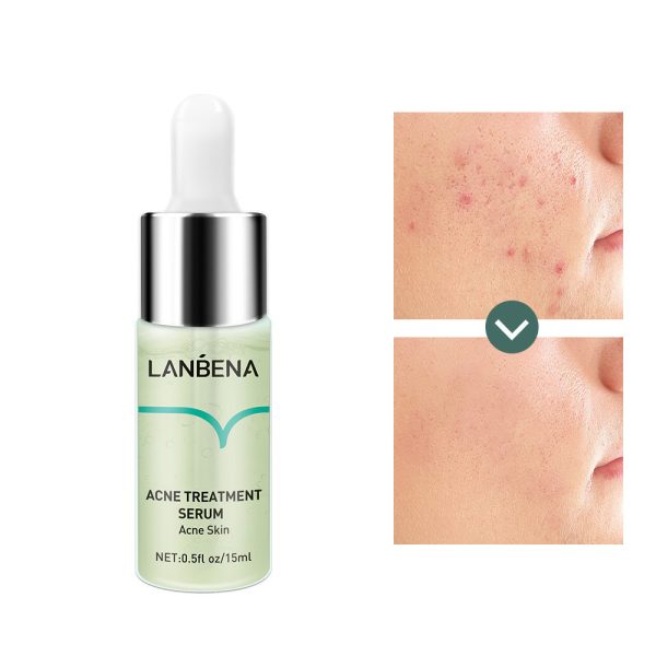 Lambina Anti-acne Original Liquid For Anti-acne Repair And Diminish Acne Marks - Image 5