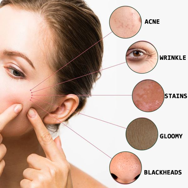 Acne Marks Blackhead Brightening Skin - Image 4